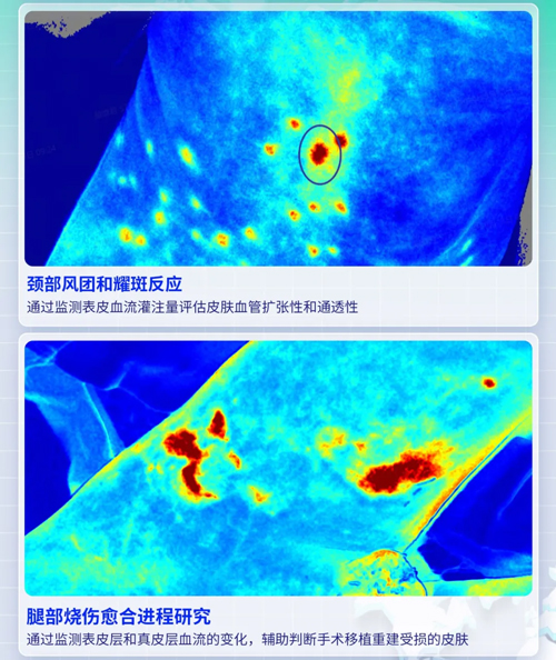 k8凯发激光散斑血流成像系统获批FDA认证