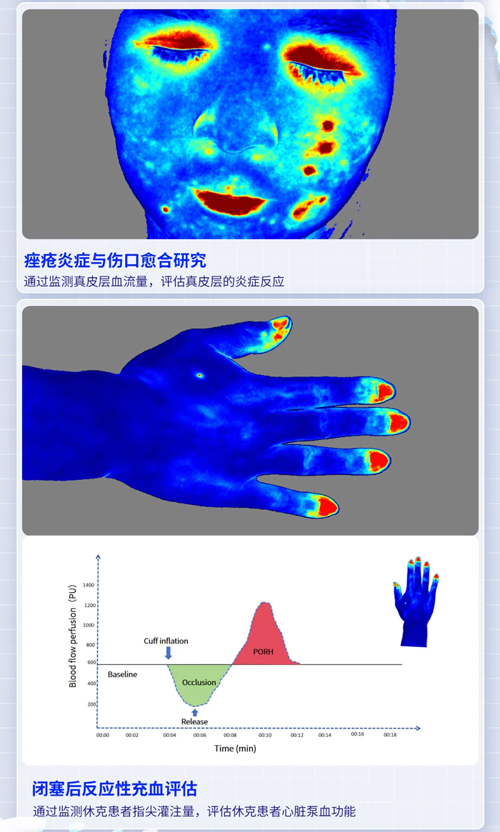 k8凯发激光散斑血流成像系统获批FDA认证