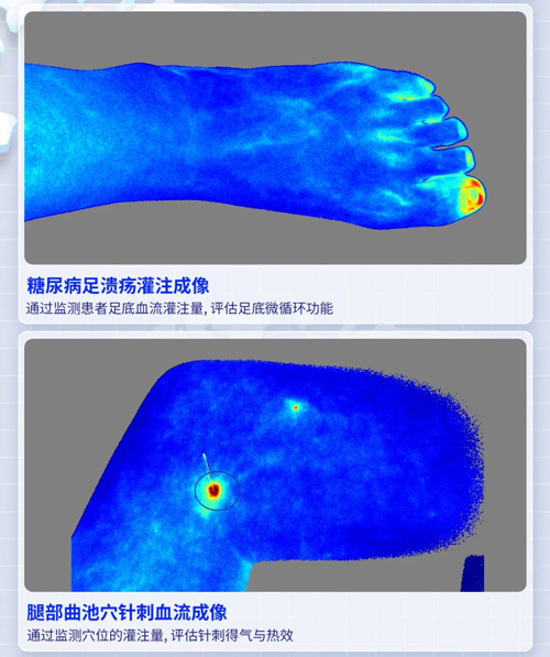 k8凯发激光散斑血流成像系统获批FDA认证